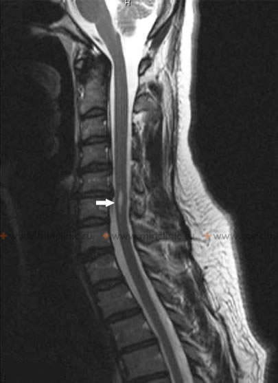 На МРТ шейного отдела спинного мозга определяется полость сирингомиелии на уровне тела С6 позвонка (указана стрелкой).